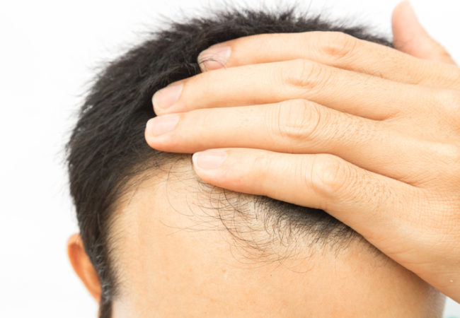 PRP Hair Loss Treatment Ocean Grovet NJ